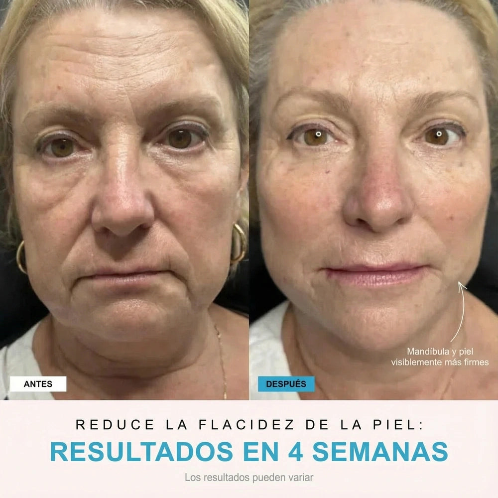 NivaLift | Dispositivo reafirmante facial + 1 SÉRUM DE REGALO